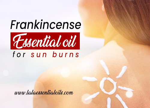 Frankincense Essential oil for sun burns  