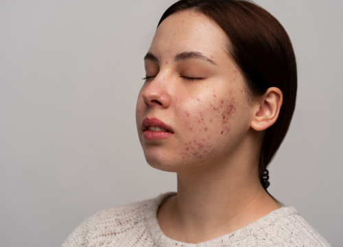 Banish Acne Scars with 10 Essential Oils